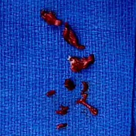 Blood Clot pieces on blue gauze pad