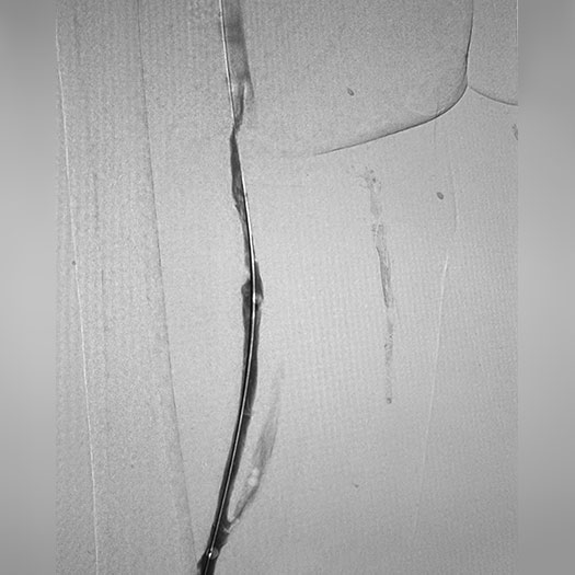 Angiogram of occluded blood vessel