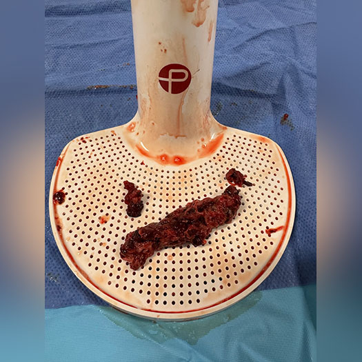 Blood Cloot on the Penumbra Engine Clot filter