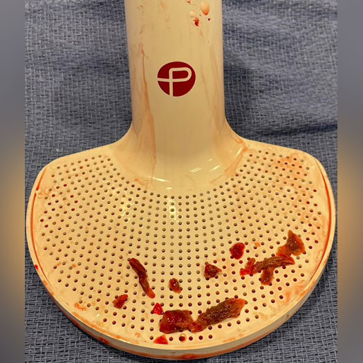 Blood Clots in the Penumbra ENGINE cannister