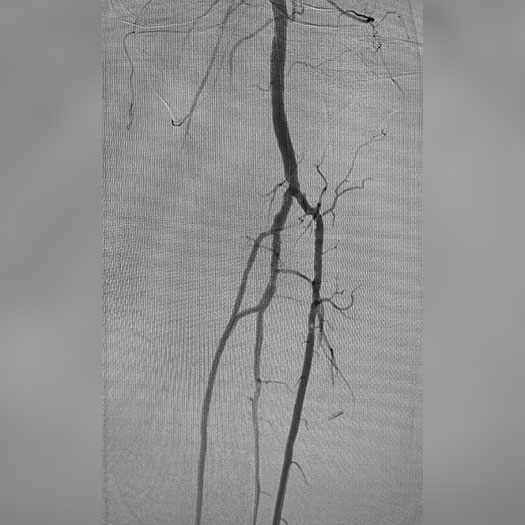 Angiogram of cleared blood vessel