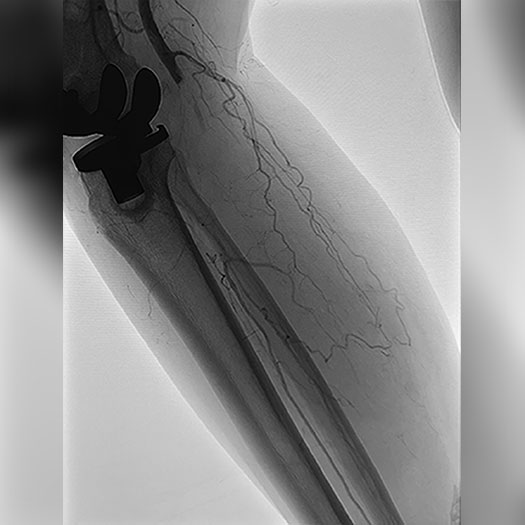 Angiogram of an occluded blood vessel