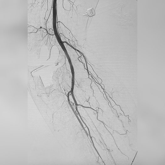 Angiogram of cleared blood vessel