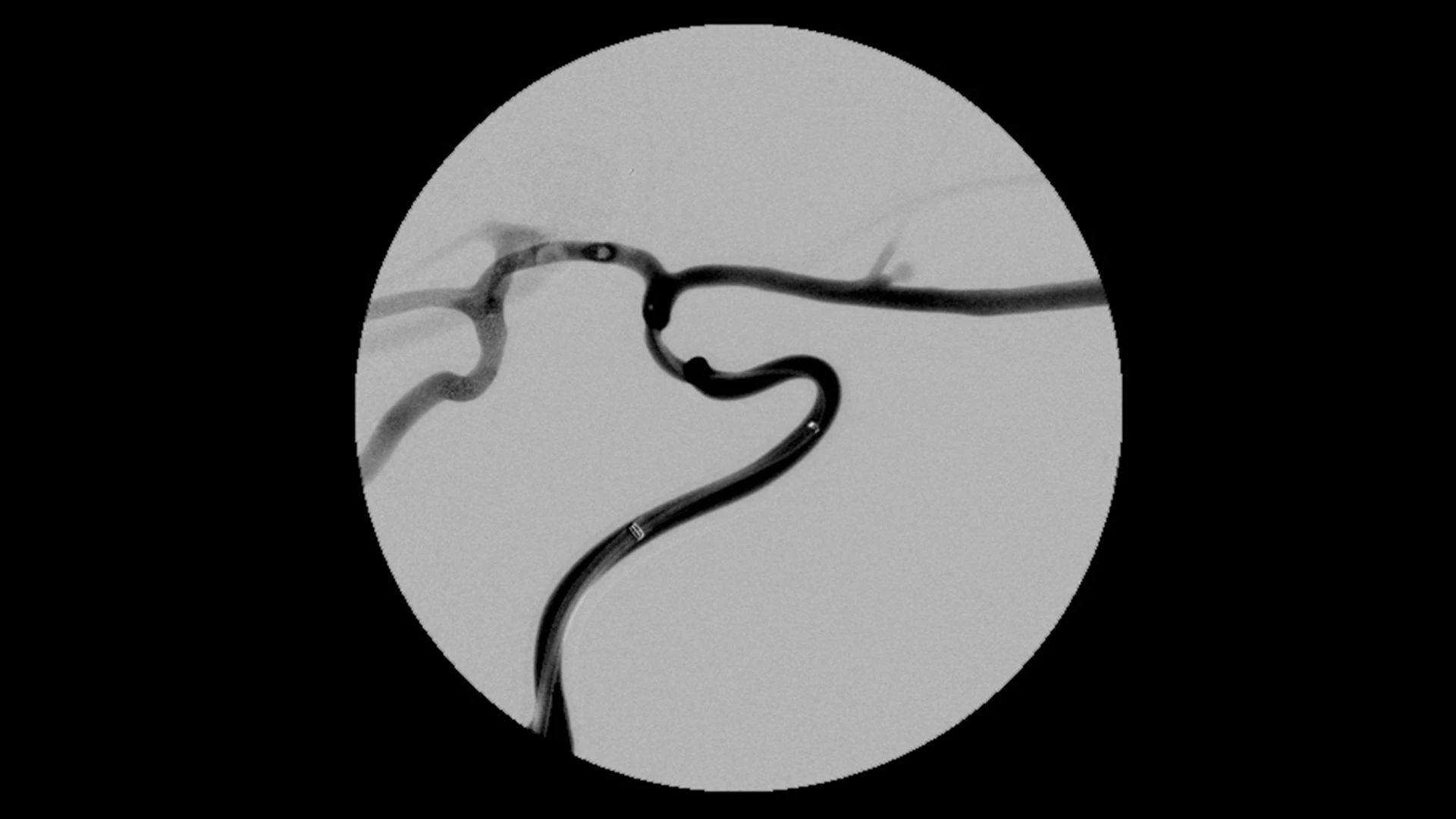 Angiogram of MIDWAY in a vessel