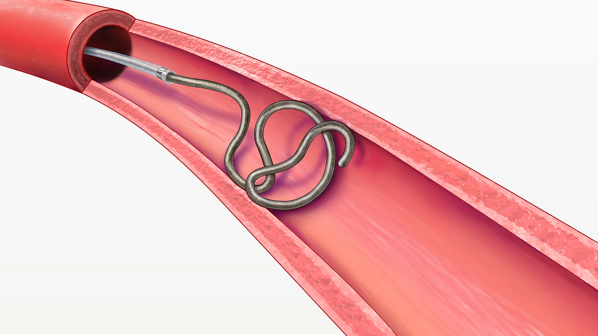 Illustration of Deployment of POD400 anchor segment within a vessel in the body