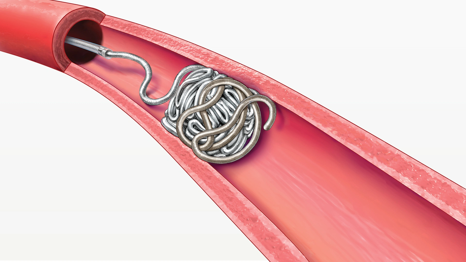 Illustration of Deployment of PAC400 packing segment within a vessel in the body