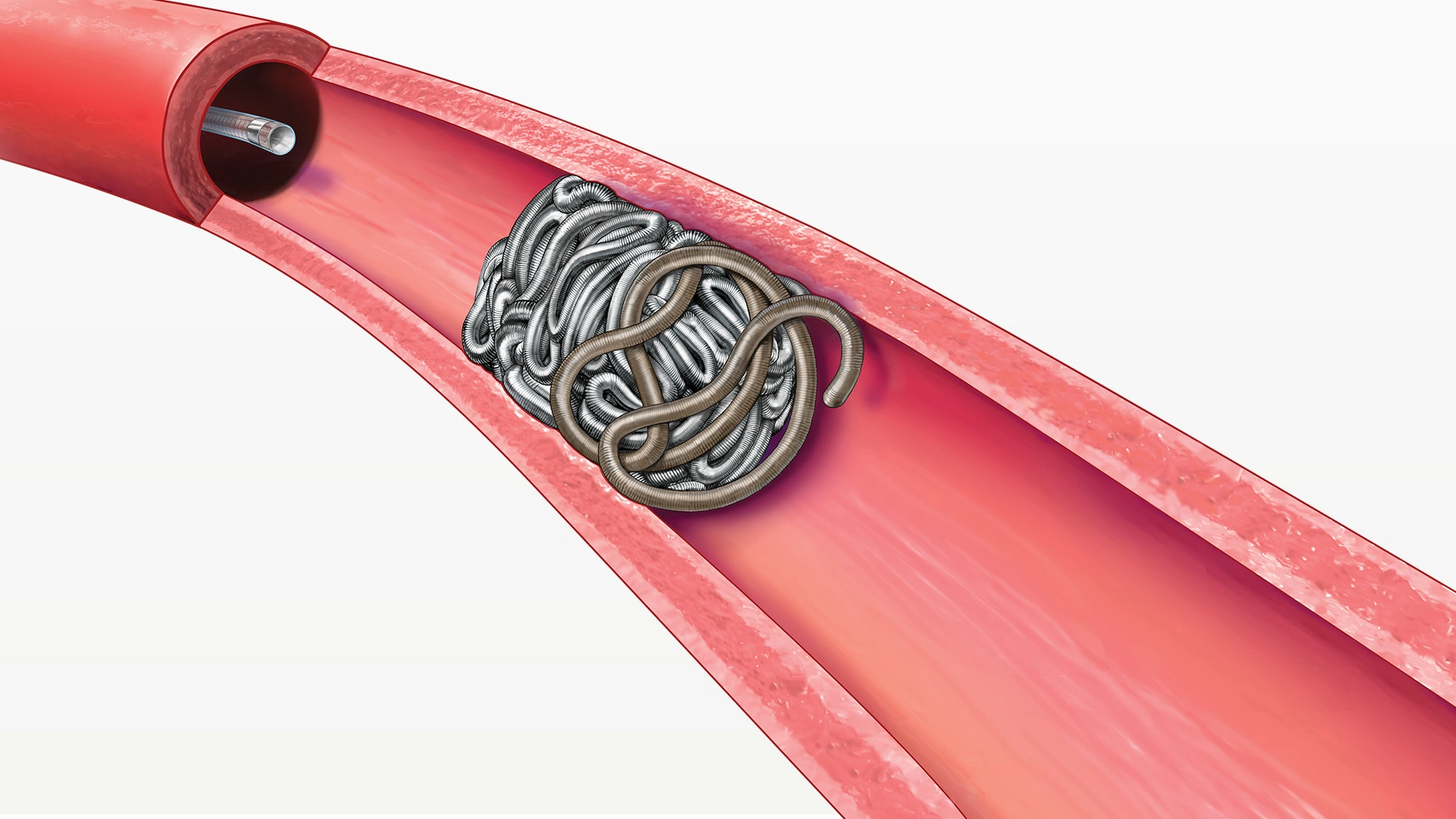 Illustration of Deployment of PAC400 behind POD400 within a vessel in the body