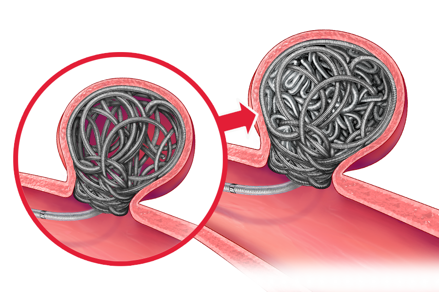 Illustration Ruby Coil System coiling and packing and aneurysm in a vessel within the body