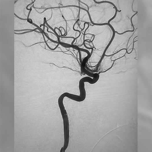 Angiogram of blood vessel