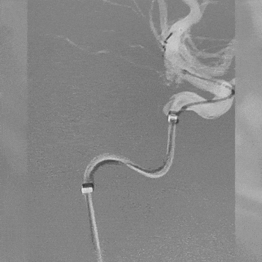 angiogram of bmx deployment