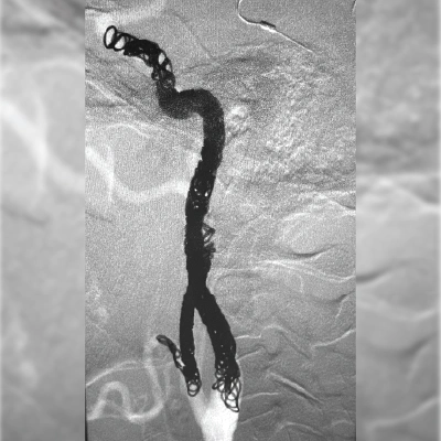 angiogram of coil deployment using ACCESS25 Delivery Microcatheter