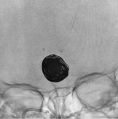 angiogram of coil deployment using ACCESS25 Delivery Microcatheter