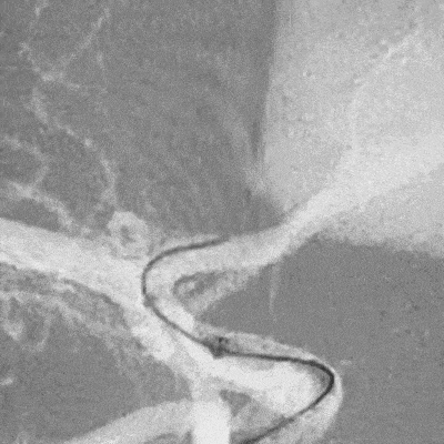 animation of ACCESS25 Delivery Microcatheter tracking deployment in anterior communicating artery