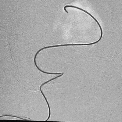 animation of ACCESS25 Delivery Microcatheter tracking