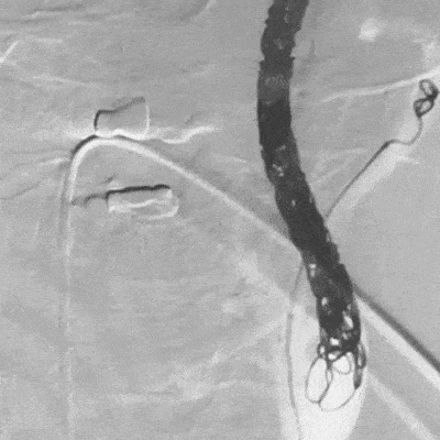 animation of ACCESS25 Delivery Microcatheter and coil deployment