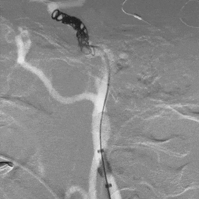 animation of ACCESS25 Delivery Microcatheter and coil deployment