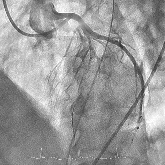 Angiogram of the left anterior descending (LAD) artery occluded with thrombus beginning in the proximal segment. Interventional wire can be seen coursing the LAD, defining the extent of thrombus.