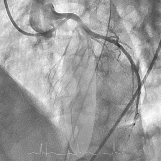 Portion of the LAD territory highlighted. Seen again is the interventional wire for reference.