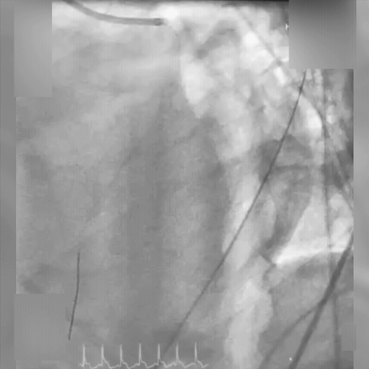 LAD angiography status-post aspiration thrombectomy with CAT RX and stent implantation in the offending LAD lesion.