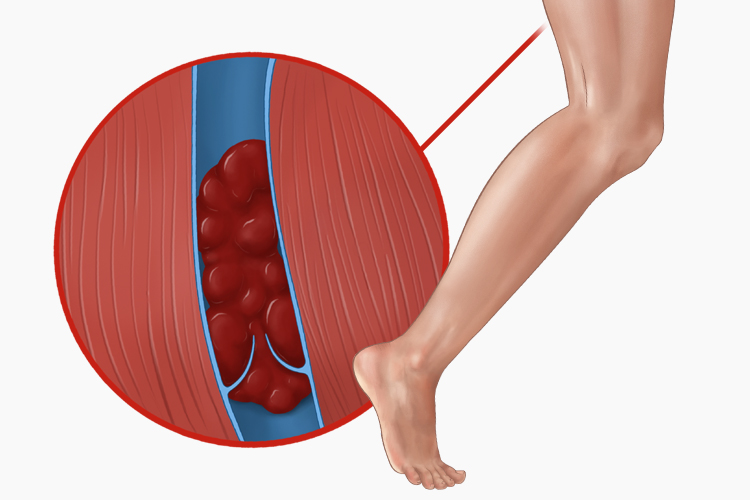 Illustration depicting lower extremity venous thrombus