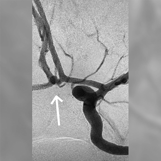 angiogram of neuro aneurysm