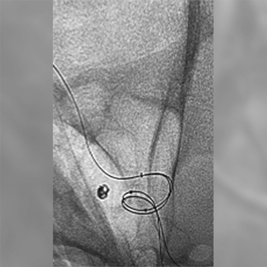 angiogram of embolization coil in vessel