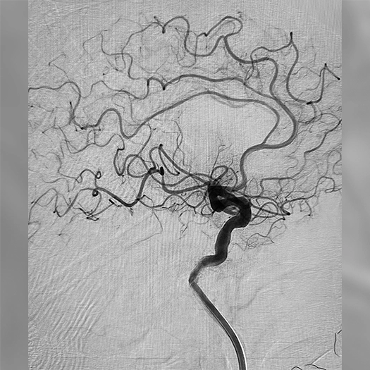 Angiogram of occluded blood vessel