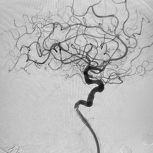 Angiogram of cleared blood vessels