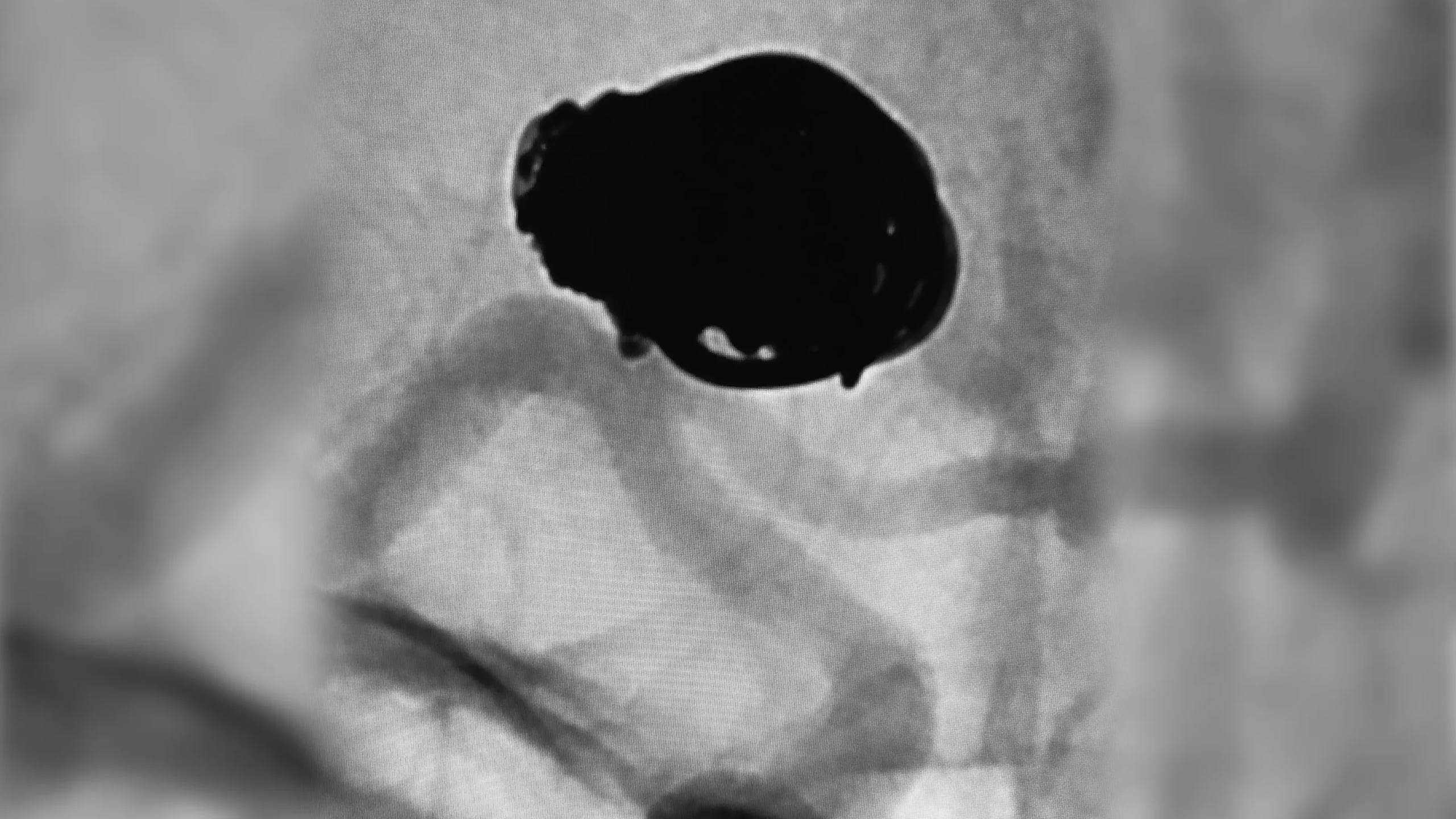 angiogram of an embolization coil place in an aneurysm