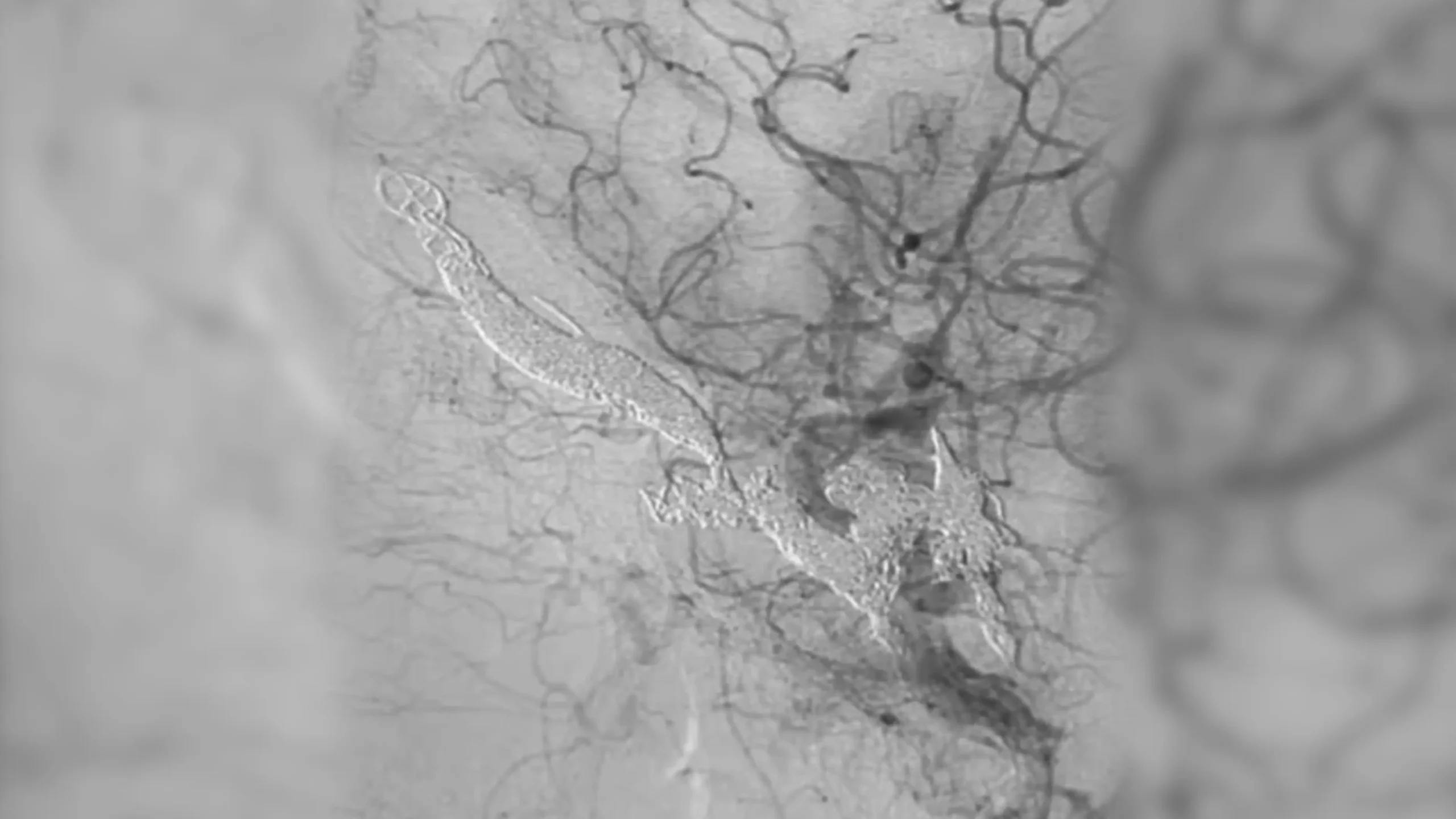 angiogram of a fistula