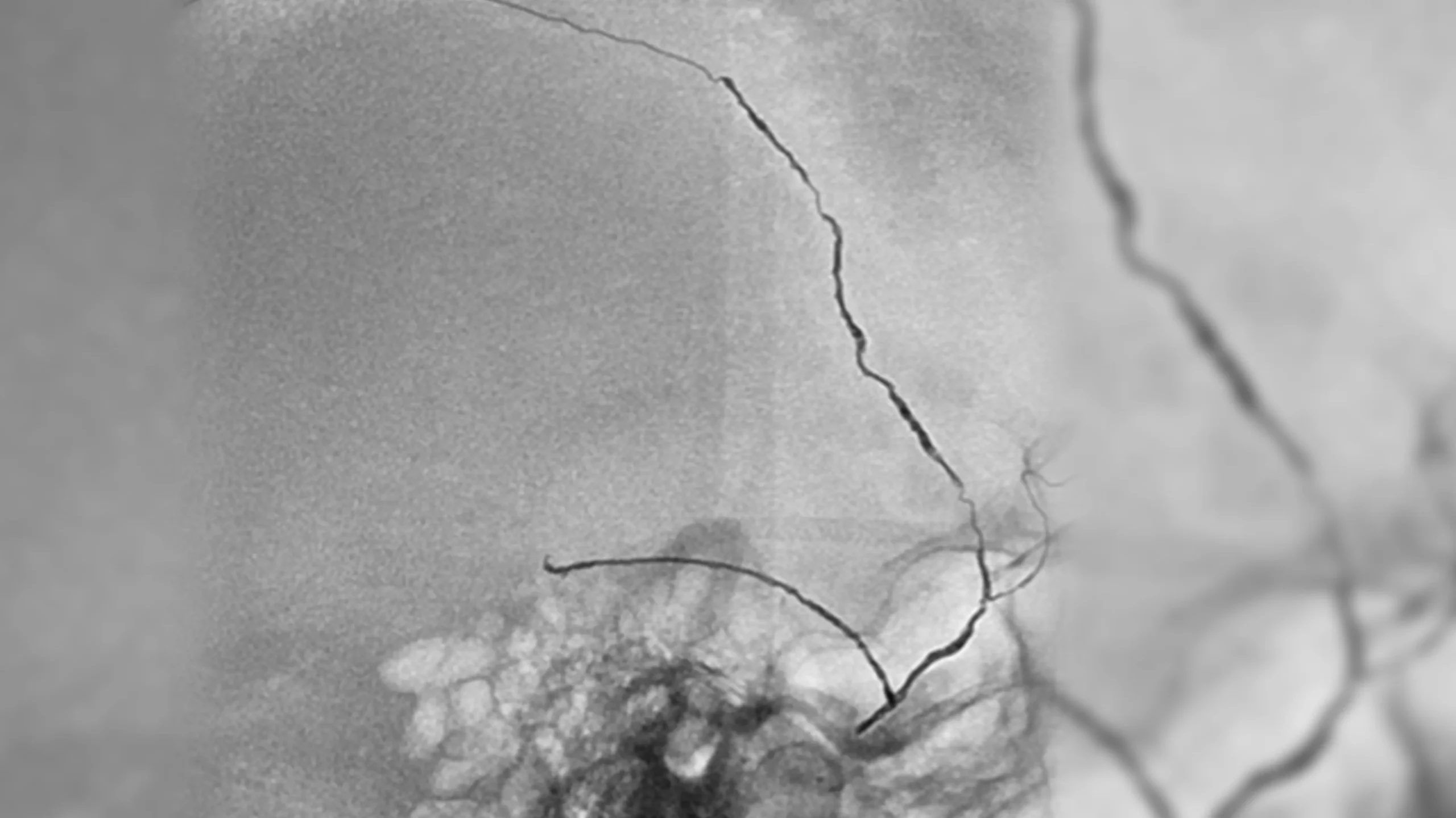 angiogram of embolization coils in a vessel