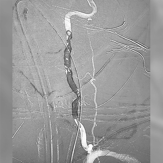 Angiogram of coils deployed into a vessel