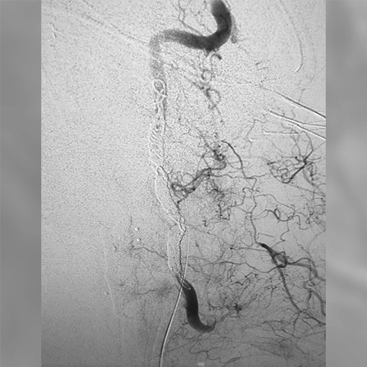 Angiogram of coils deployed into a vessel