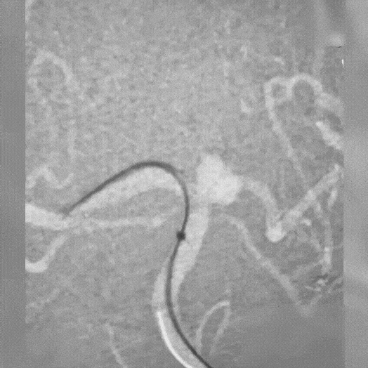 animated angiogram of neuro embolization coil deployment