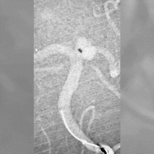 animated angiogram of neuro embolization coil deployment