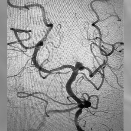 Neuro Aneurysm angiogram