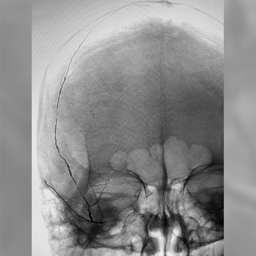 Angiogram of deployed coils