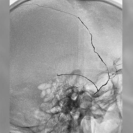 Angiogram of deployed coils