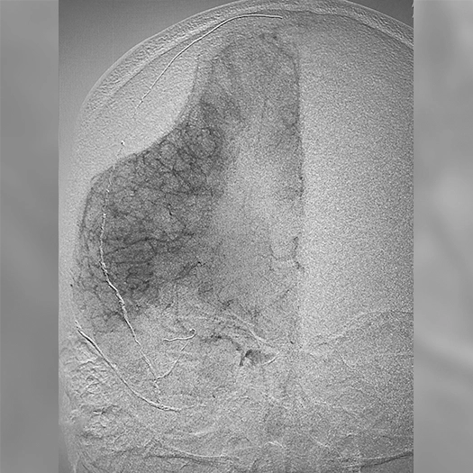 Angiogram of deployed coils