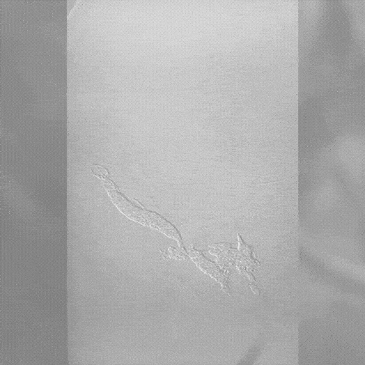 Embolization of fistula angiogram