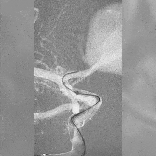 Coil Deployment to an Aneurysm