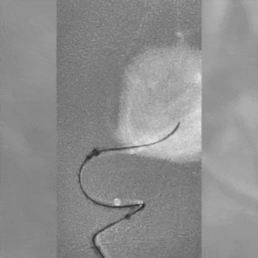 Coil Deployment to an Aneurysm