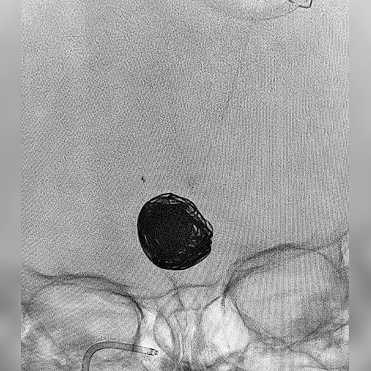 Embolization Coil deployed to an aneurysm