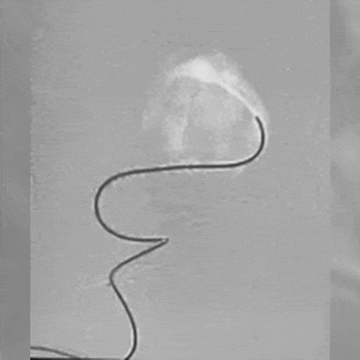 Coil Deployment to an Aneurysm