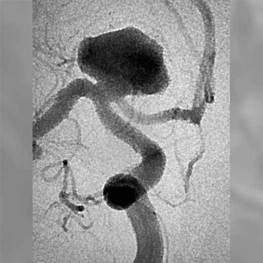 neuro aneurysm embolization