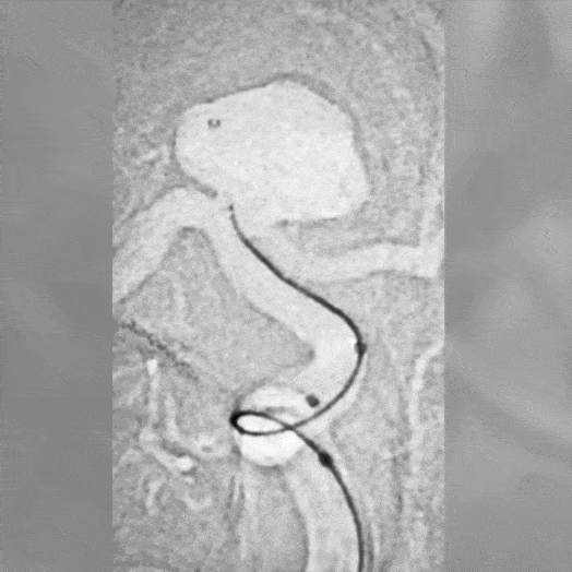 Coil deployment in vessel angiogram
