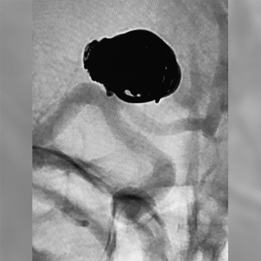 angiogram of coil deployed into neuro embolization