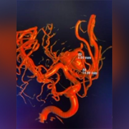 Neuro Aneurysm 3D Render