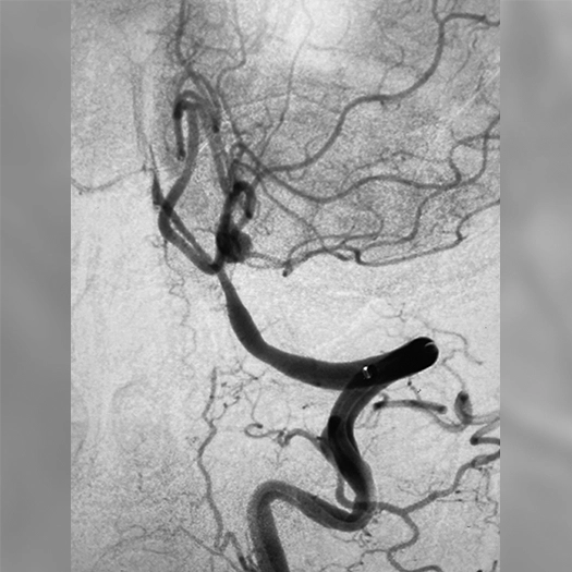 angiogram of an aneurysm