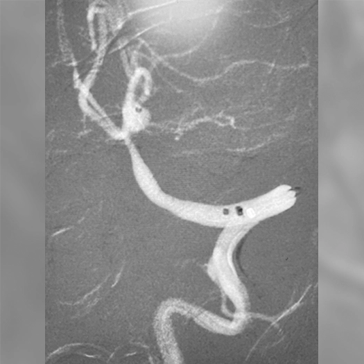 angiogram of a coil deployed to an aneurysm